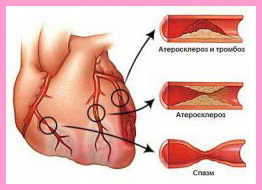 Prevenirea aterosclerozei cum să protejeze și să păstreze sănătatea și tineretul vaselor de sânge, blog personal