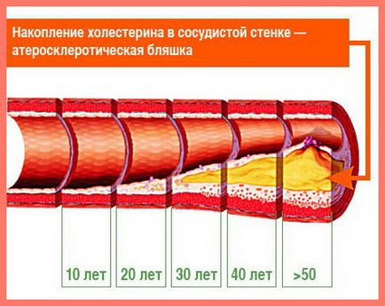 Профілактика атеросклерозу як захистити і зберегти здоров'я і молодість судин, особистий блог