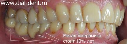 Protézisek élő fogat fémkerámia