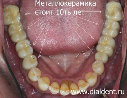 Az ortopéd fogak életben cermet (fémkerámia fogat keresztül) Protézisek élő fogat fémkerámia
