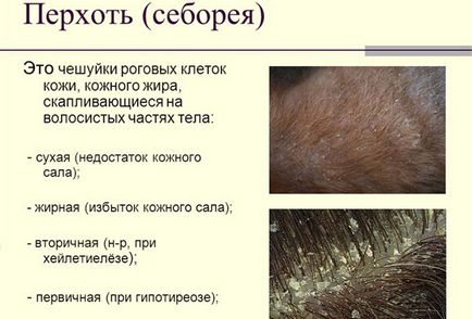 Psoriasis, seborrhoeás az arcon és a fej és annak kezelése (seborrheás) Psoriasis, seborrhoeás az arc és a fej és annak kezelése