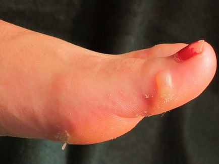 A foltok a láb cukorbetegség típusai, fotó, kezelés, megelőzés (diabetes) A foltok a láb cukorbetegség típusai, fotó, kezelés, megelőzés