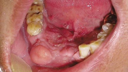 Gum Cancer Symtomas și stadiile bolii, tratamentul oncologiei