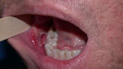 Gum Cancer Symtomas și stadiile bolii, tratamentul oncologiei