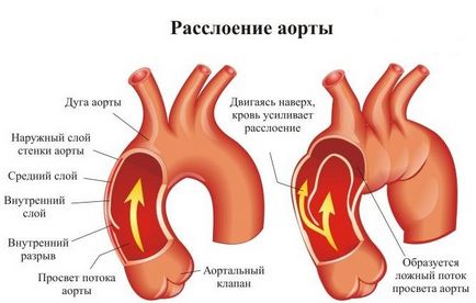 Stratificarea rupturii aortei, exfolierea anevrismului, cauze, simptome