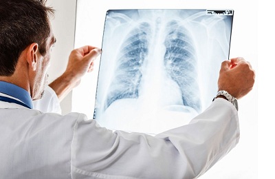 Рентгенограма раку легенів як виглядають метастази і покаже чи рентген пухлина