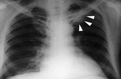 Radiografia cancerului pulmonar ca metastazele arata si va X-ray arata o tumora