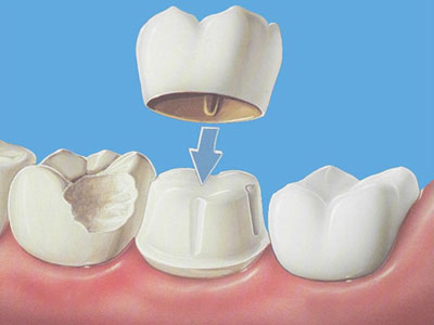 Реставрація передніх зубів який вид протезування вибрати