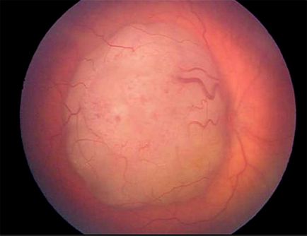 Retinoblastomul ochiului la copii - cauze, simptome și tratament