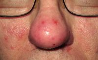 Rosacea sau acnee, zdravoe