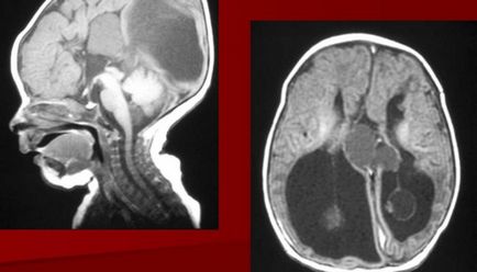 Displazie displazie a creierului la copii - sindrom Morcière