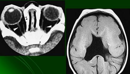 Септохіазмальная дисплазія головного мозку у дітей - синдром морсіера