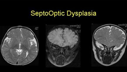 Септохіазмальная дисплазія головного мозку у дітей - синдром морсіера