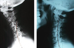 Шийний лордоз випрямлений що це значить, фізіологічного лікування