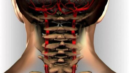 Sindromul arterei vertebrale cu simptome și tratament pentru osteochondroza cervicală