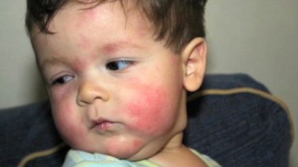 З якого віку можна давати гематоген дитині чим корисний, шкода, зі скількох років давати, алергія