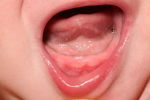 Momeală cu dentiție la copii - poate exista un nas curbat în această perioadă