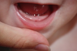 Momeală cu dentiție la copii - poate exista un nas curbat în această perioadă