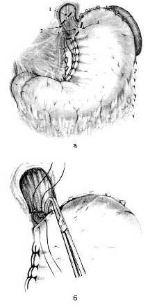 A modern technológia a sebészi kezelése achalasia II-III szakasz - cikkek