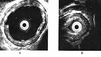 A modern technológia a sebészi kezelése achalasia II-III szakasz - cikkek