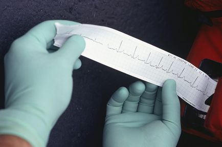 Angina pectorală vasospastică, tratamentul variantei anginei pectorale