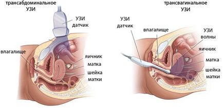 Трансвагинальное узі особливості, методика, показання