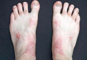 Crăpăturile din picioare împiedică apariția și cauzele