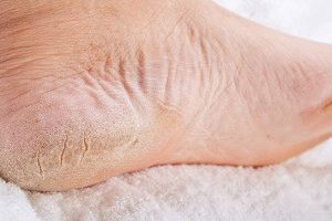 Тріщини на ногах профілактика появи і причини виникнення