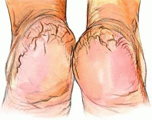 Тріщини на ногах профілактика появи і причини виникнення