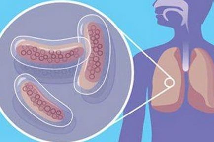 Tuberculoza și interconectarea fumatului, simptome și tratament