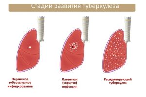 Туберкульоз від куріння