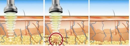 Ультразвукова кавітація, застосування в косметології для схуднення, відгуки
