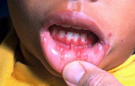 Copilul sângerează gingiile cu stomatită, simptome, tratament, prevenire