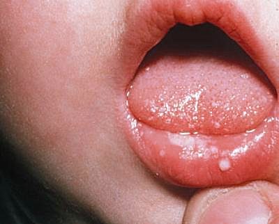 Copilul sângerează gingiile cu stomatită, simptome, tratament, prevenire