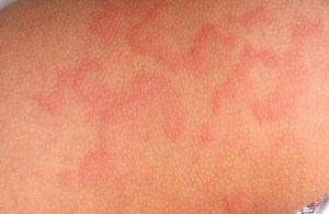 Típusú csalánkiütés és allergiás pseudoallergic