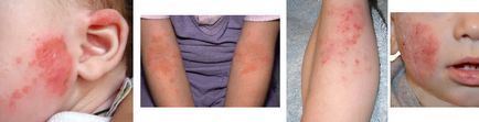 Вірусний дерматит (інфекційний дерматоз) симптоми, комплексне лікування, фото