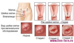 Papilomavirusul uman la femeile din ginecologie cauzează tratamentul