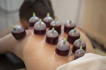 Hijama cu prostatită - tratament hemoragic