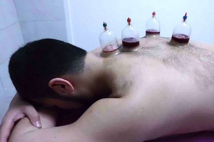 Hijama cu prostatită - tratament hemoragic