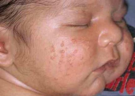 Boli ale pielii și ombilicului - boli ale nou-născuților - boli de copil - nave de prieteni