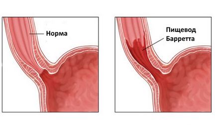 Aruncarea de acid și alimente din stomac în esofag cauzează tratament