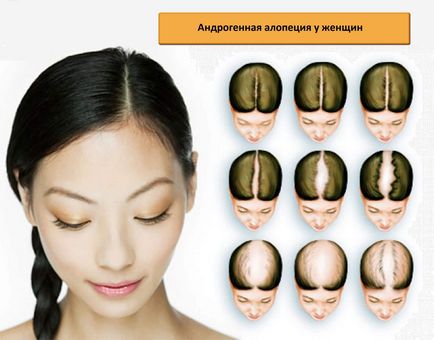 Alopecia hormonală feminină și alopecia androgenică