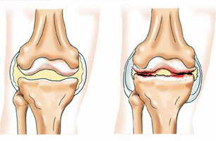 Arserea în genunchi determină apariția și tratamentul durerii