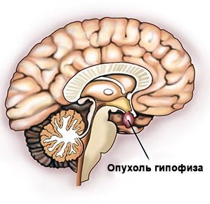 Simptome, tratament și prognostic al adenomului pituitar