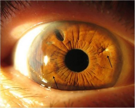Afakiya ochi (absența lentilei în ochi) ce înseamnă, semne, metode de corecție și altele