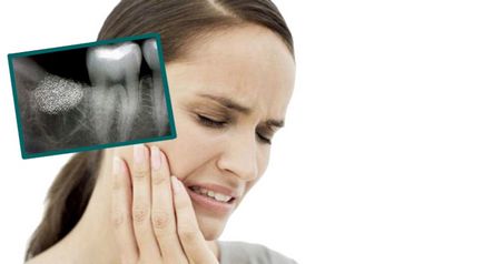Alveolita după extragerea dinților - simptome și tratament