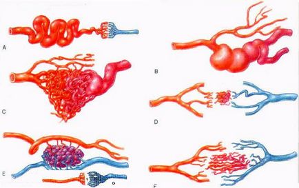 Arteriovenosus fejlődési rendellenesség az agyban