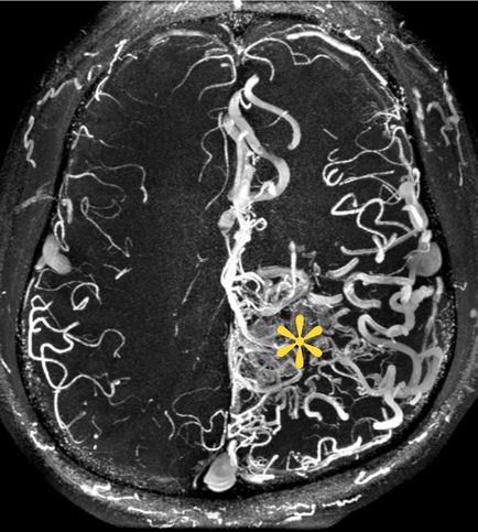 Arteriovenosus fejlődési rendellenesség az agyban