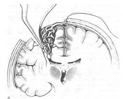 Malformații arteriovenoase ale creierului