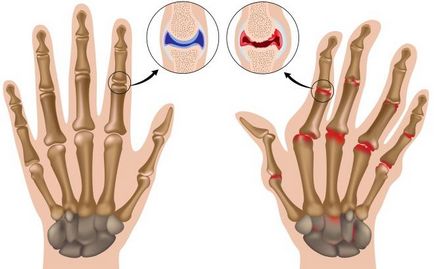 Артрит пальців рук симптоми і лікування